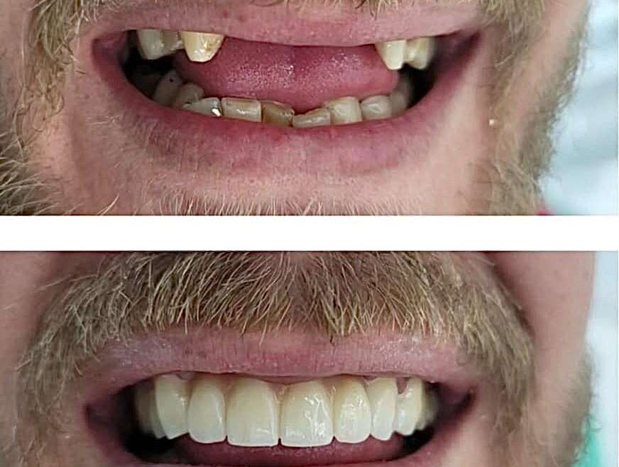 Laser Dentistry: The New Way to Treat the Smile