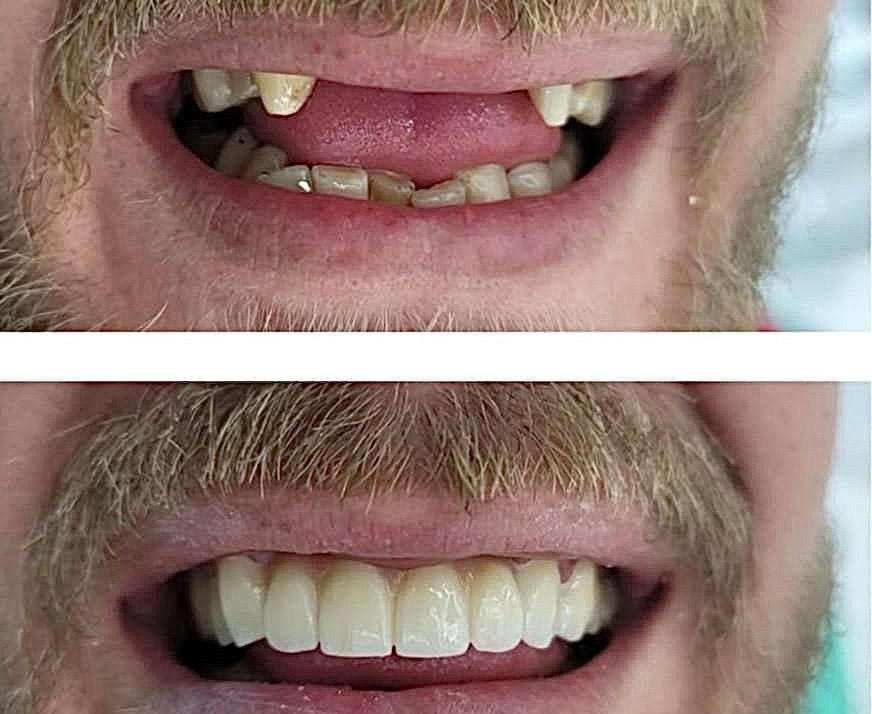 Laser Dentistry: The New Way to Treat the Smile