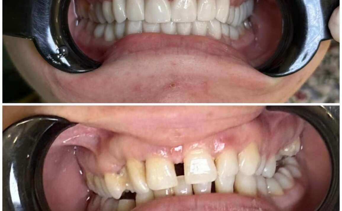 There’s A Lot You Can Do  To Prevent Tooth Loss