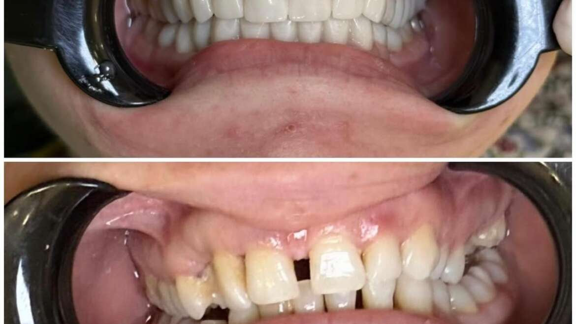 There’s A Lot You Can Do  To Prevent Tooth Loss