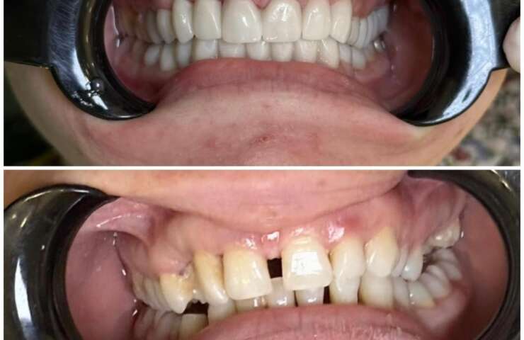 There’s A Lot You Can Do  To Prevent Tooth Loss