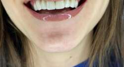 Beyond tooth decay: why good dental hygiene is important