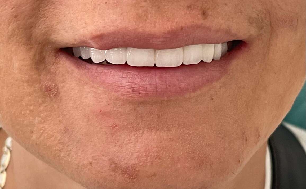 See Why Dental Implants are the Next Big Thing