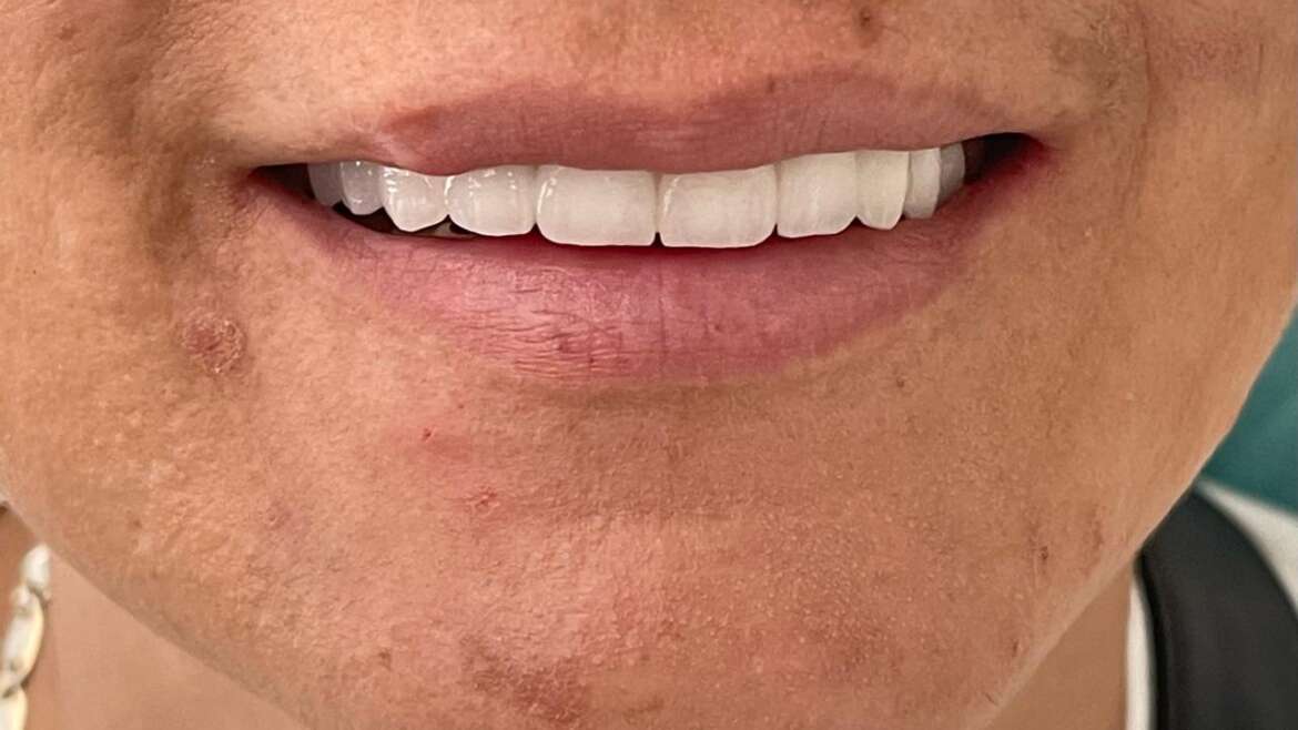 See Why Dental Implants are the Next Big Thing