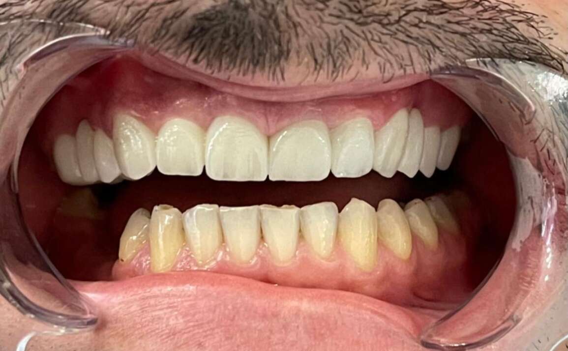 Protecting Little Teeth from Cavities