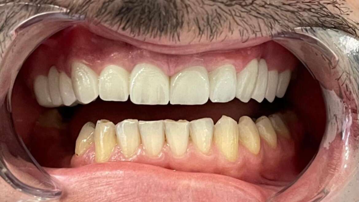 Protecting Little Teeth from Cavities