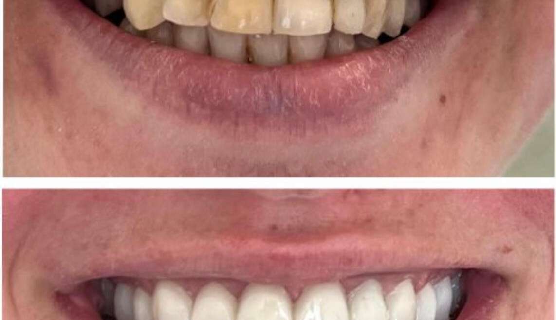 What You Need to Know About Wisdom Teeth