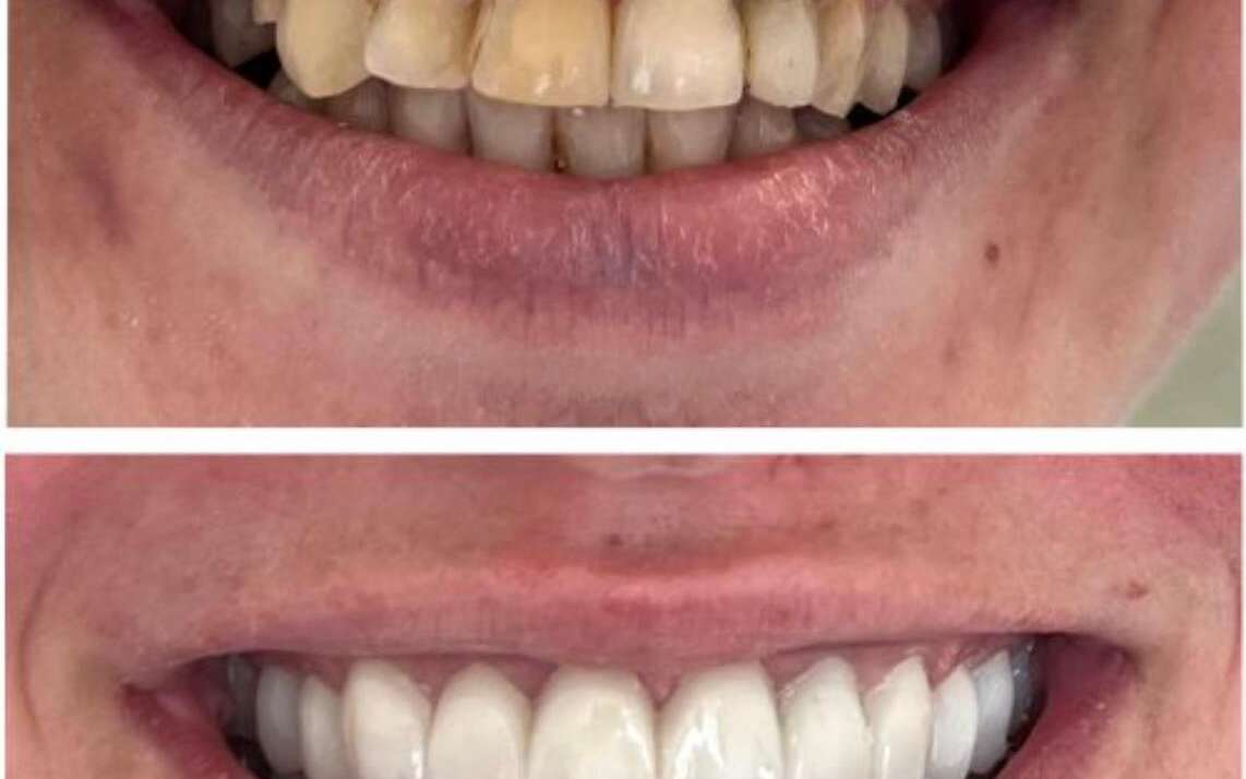 What You Need to Know About Wisdom Teeth