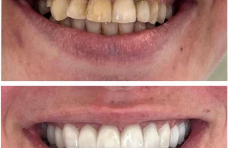 What You Need to Know About Wisdom Teeth