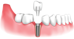 Implantes dentales: todo lo que necesitas saber.