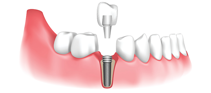 Implantes dentales: todo lo que necesitas saber.