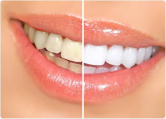Blanqueamiento dental: ¿Es seguro y efectivo?